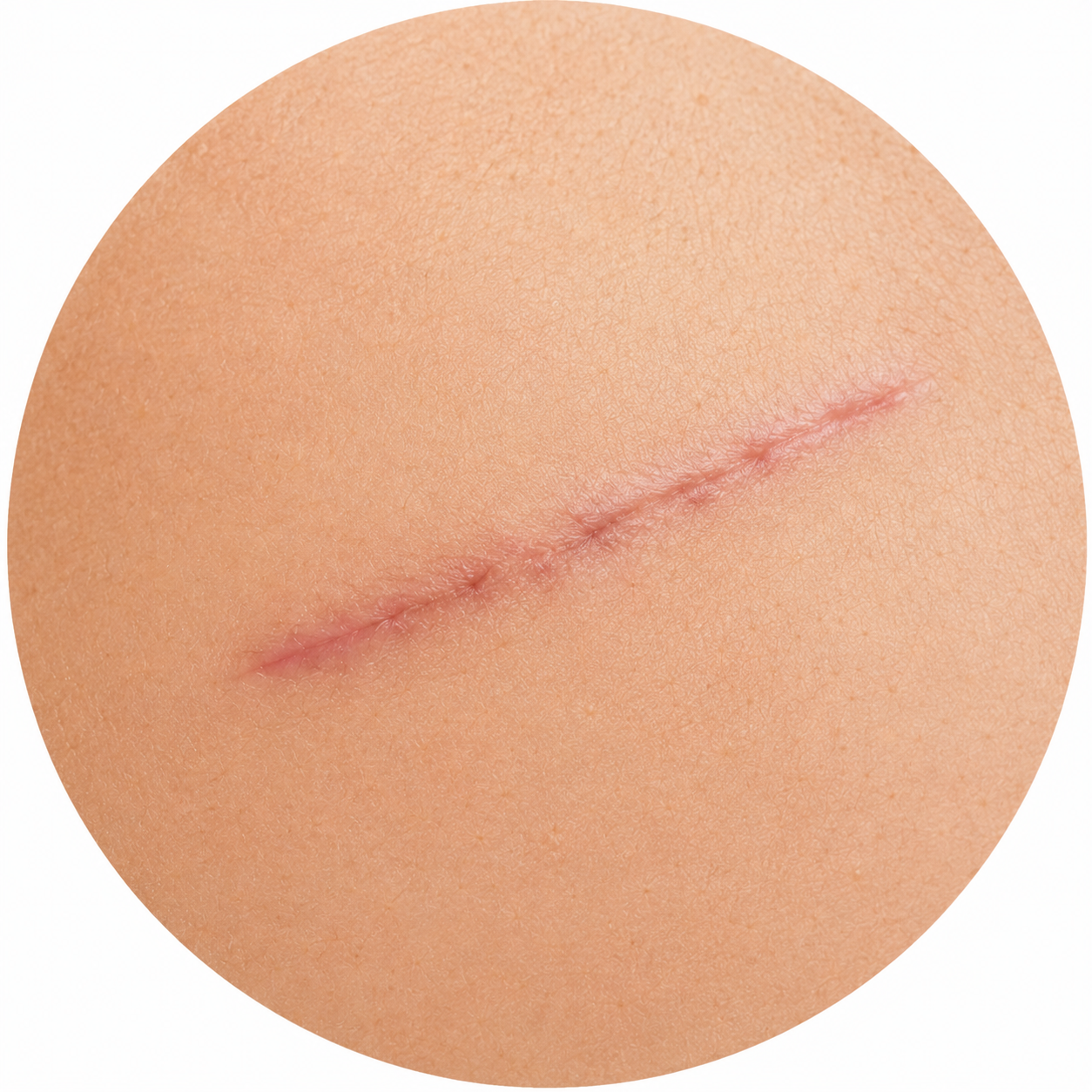 Cicatriz postoperatoria