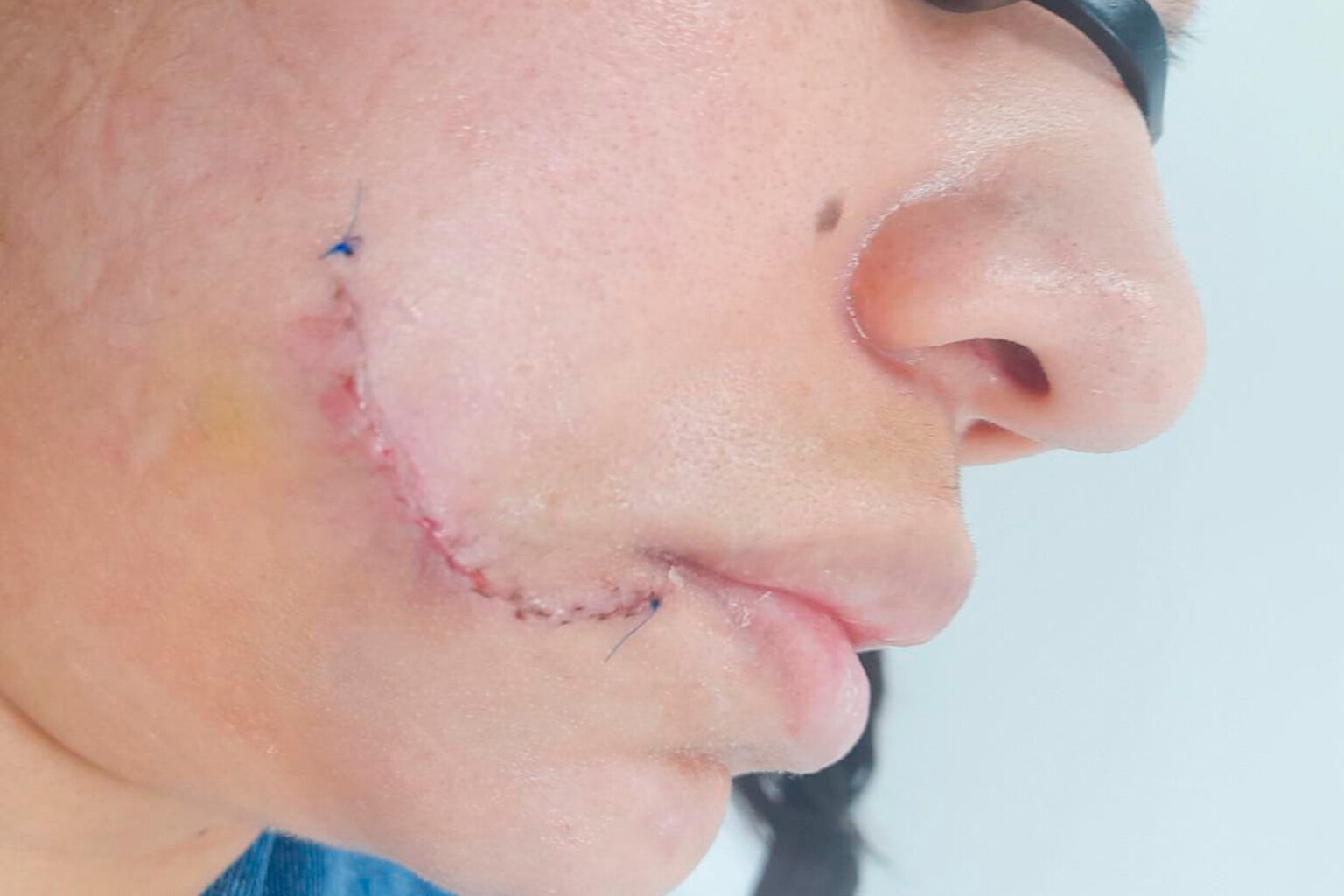 Cicatriz hipertrófica antes del uso de ScarMD