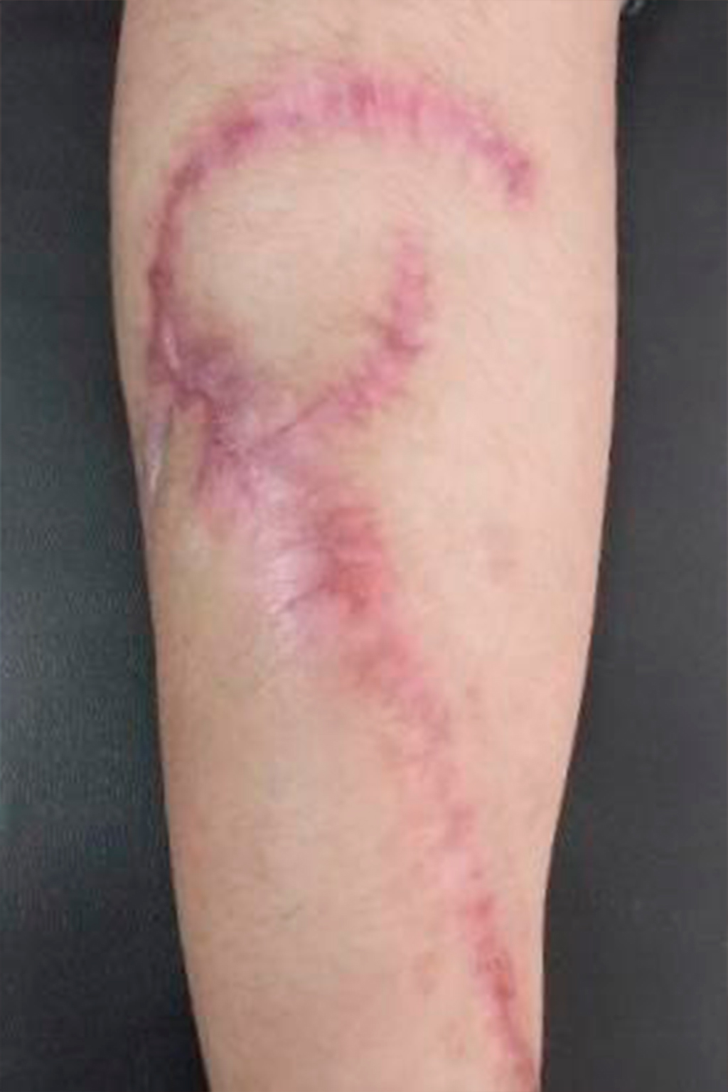 Cicatriz postoperatoria antes del uso de ScarMD