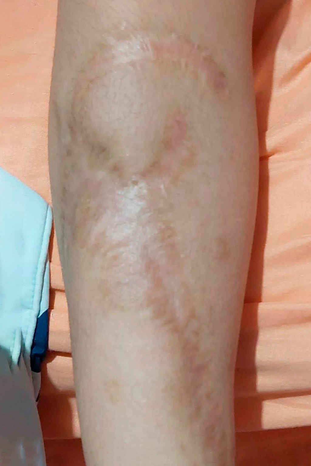 Evolución visual de cicatriz postoperatoria después del uso de ScarMD