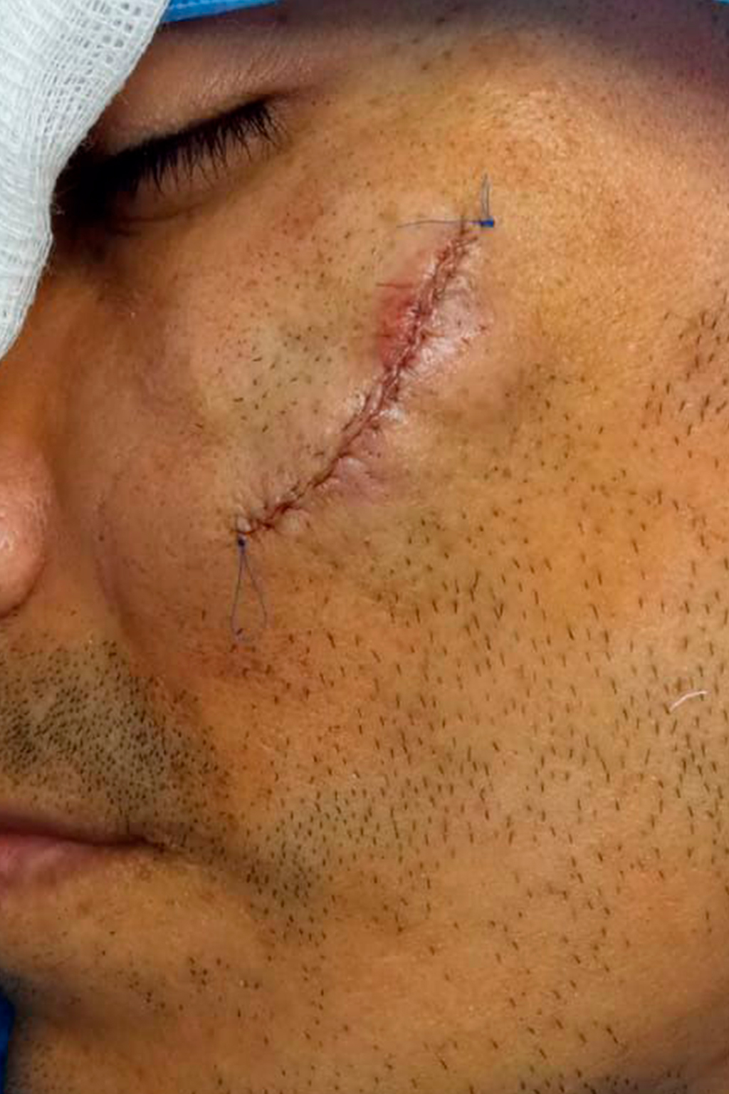 Cicatriz por quemadura antes del uso de ScarMD