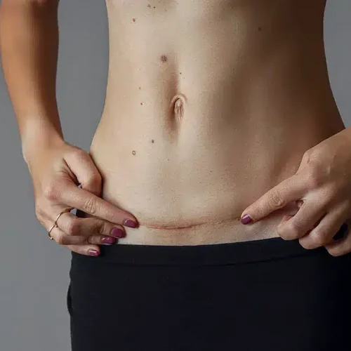 cicatrices de cirugia