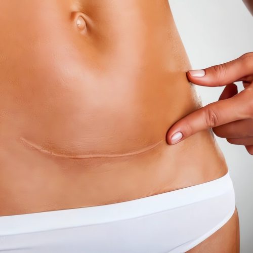 cicatriz de abdominoplastia
