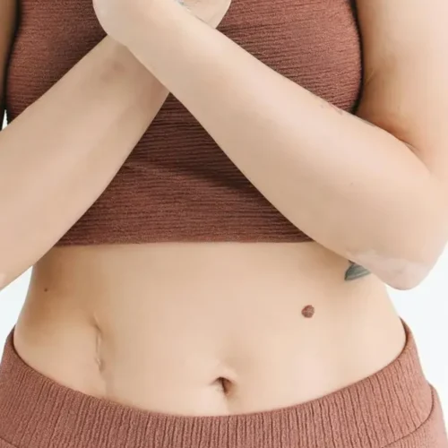 cicatriz de apendicitis
