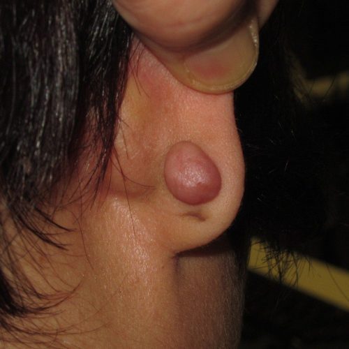 como-aplanar-una-cicatriz-queloide-1.jpg