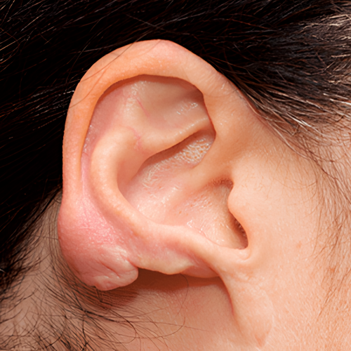 queloide en la oreja 3