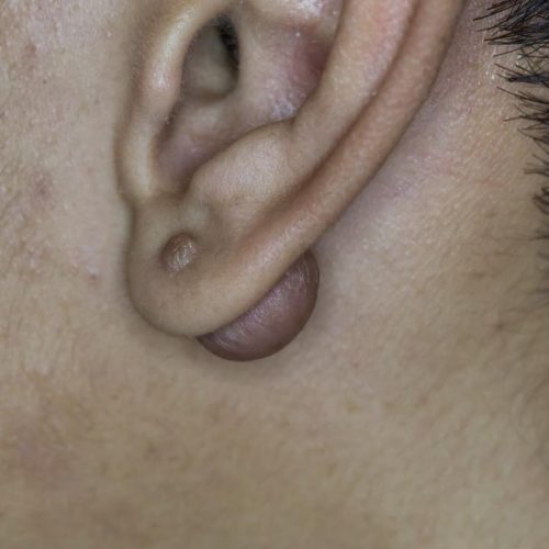 queloide en la oreja 4