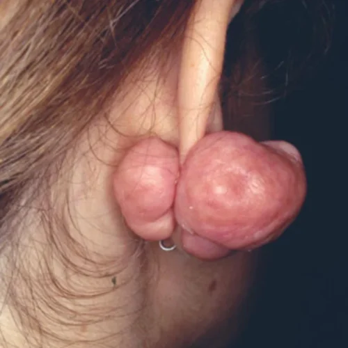 queloide en la oreja 5