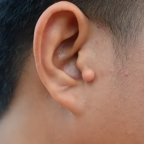 queloide en la oreja 6